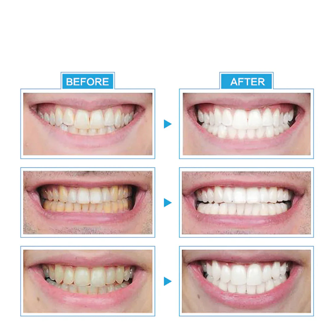 Tooth Whitening System